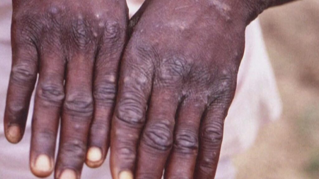Galveston County reports first probable monkeypox case