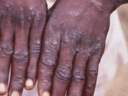 Galveston County reports first probable monkeypox case